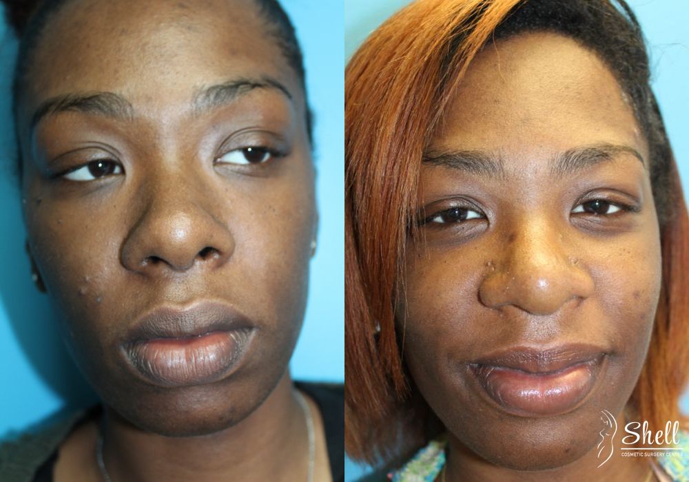 Nasal Reconstruction - Case 557