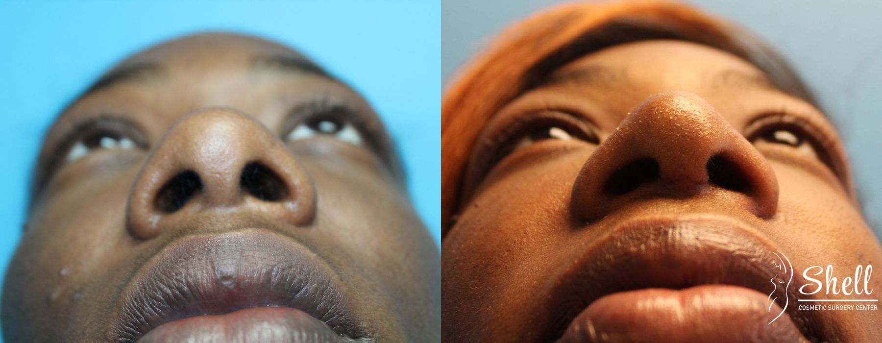 Nasal Reconstruction - Thumbnail 4