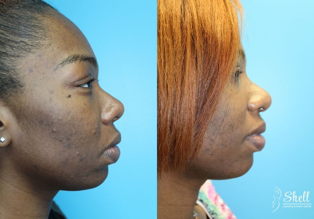 Nasal Reconstruction - Thumbnail 2