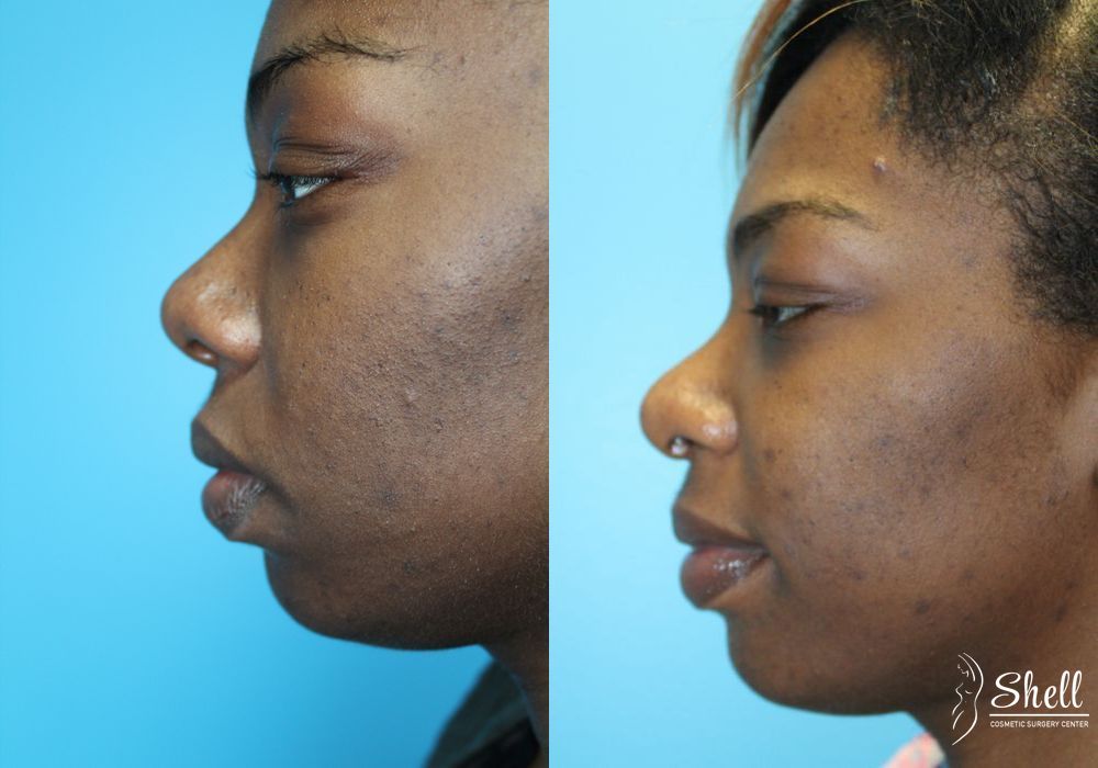 Nasal Reconstruction - Thumbnail 3