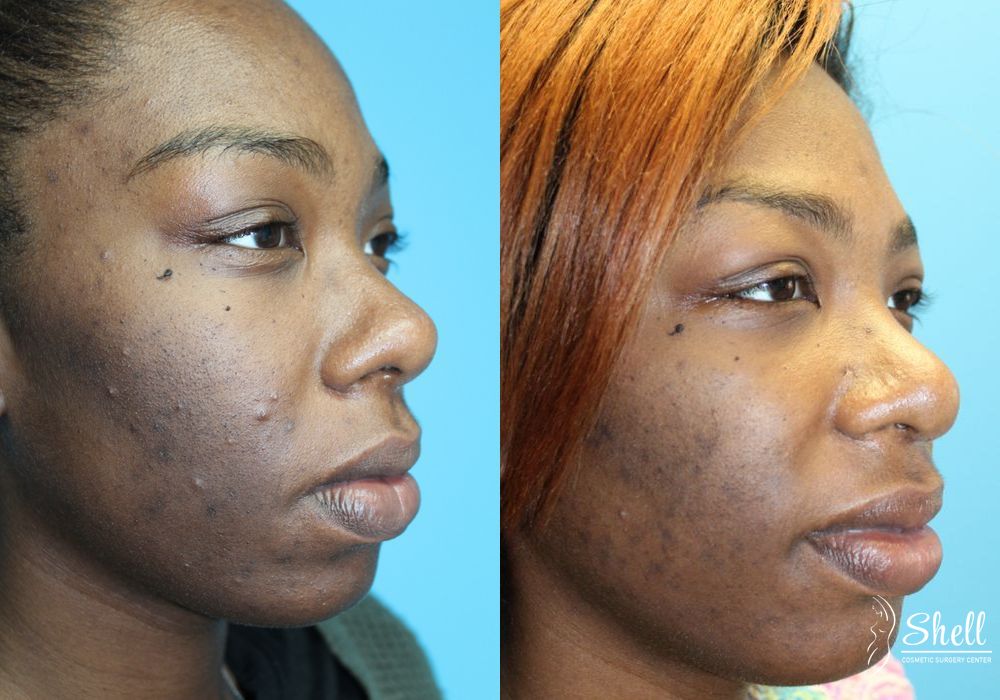 Nasal Reconstruction - Thumbnail 6