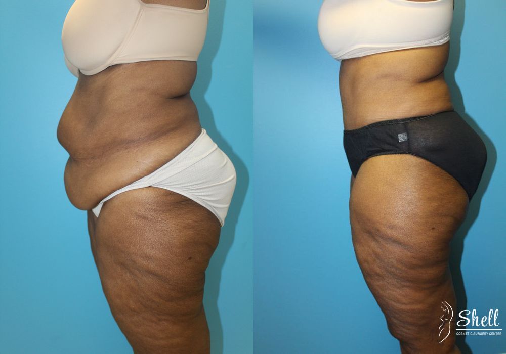 Liposuction - Thumbnail 5