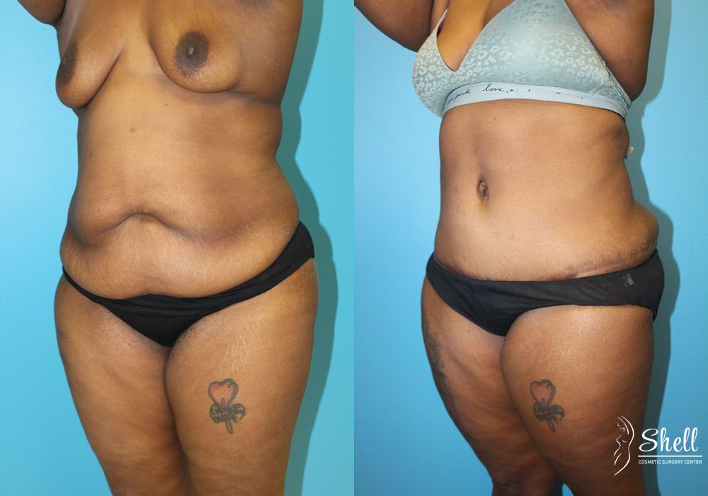 Before and after Tummy Tuck case 21571 - Angle 4