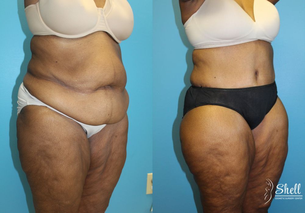 Before and after Liposuction case 21574 - Angle 2