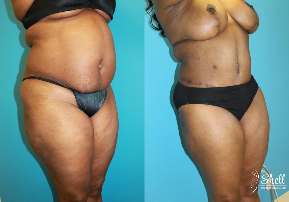 Before and after Liposuction case 21558 - Angle 2