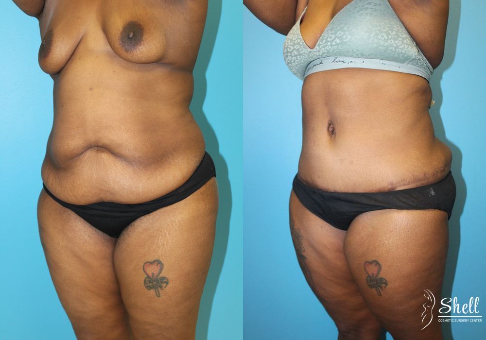 Liposuction - Thumbnail 4