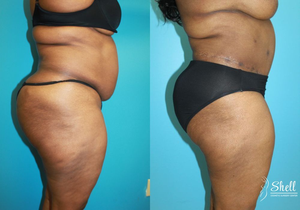 Before and after Liposuction case 21558 - Angle 3