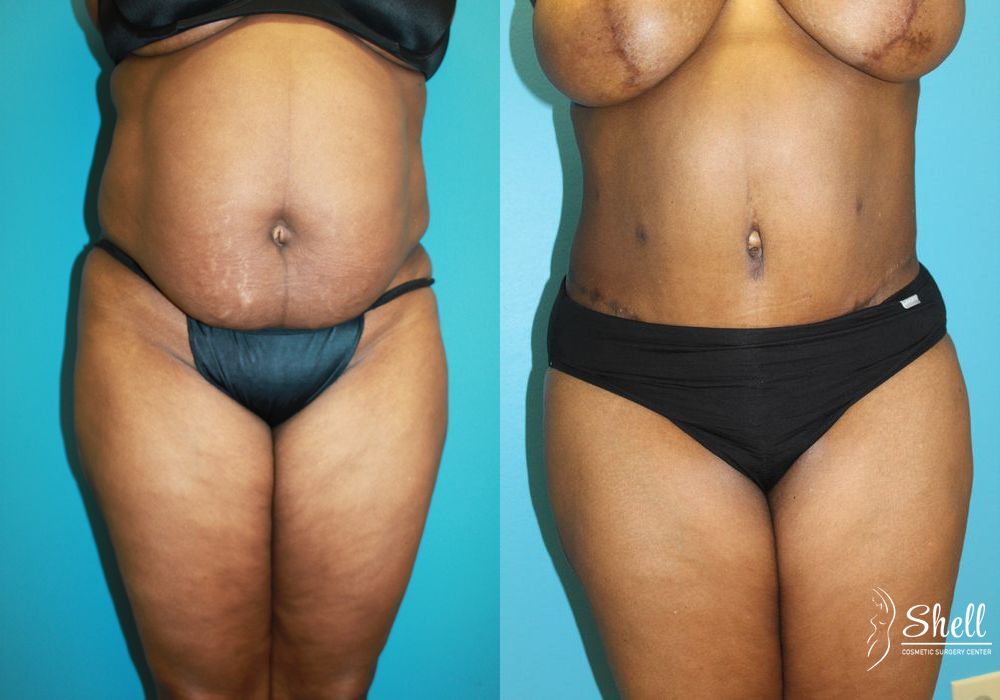 Before and after Liposuction case 21558