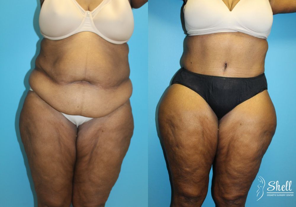 Liposuction - Case 454