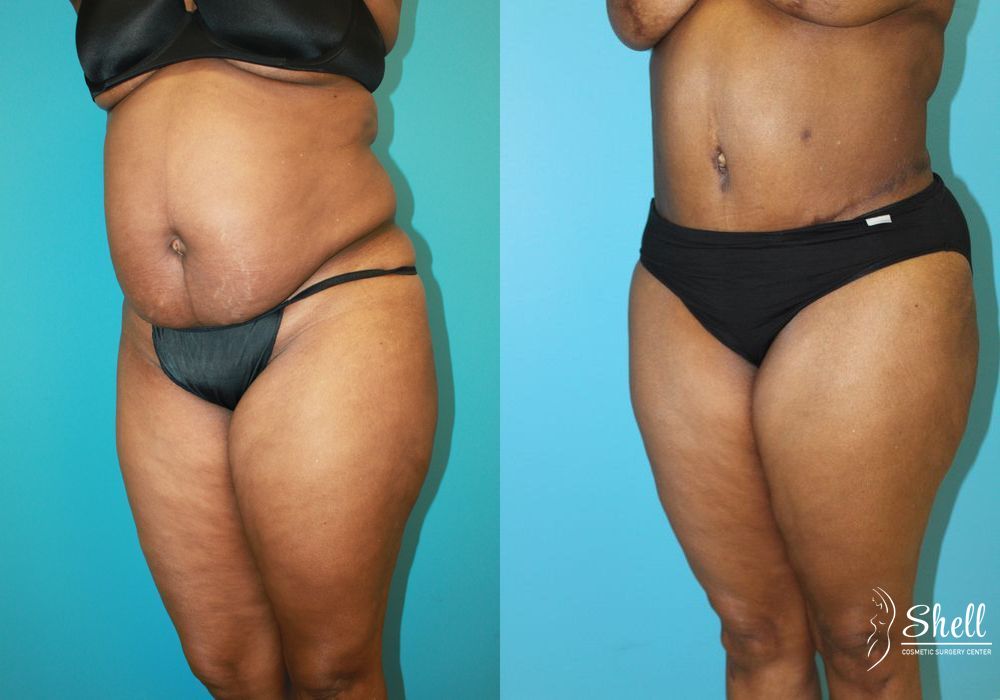 Before and after Liposuction case 21558 - Angle 4