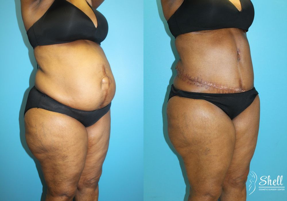 Tummy Tuck - Thumbnail 2