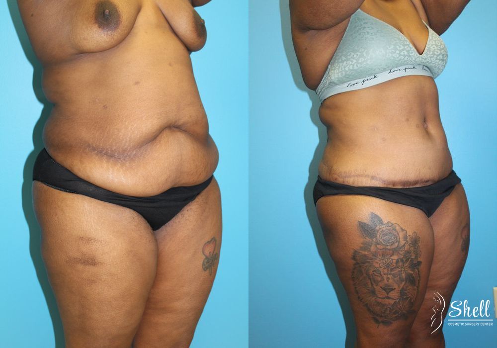 Before and after Tummy Tuck case 21571 - Angle 2