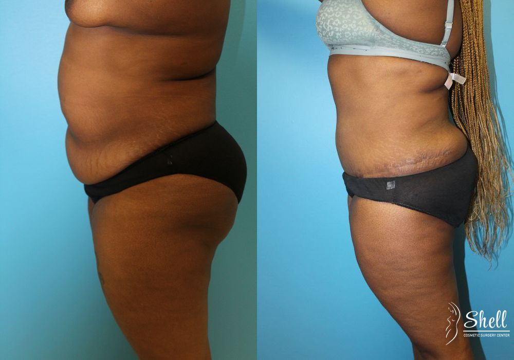 Before and after Tummy Tuck case 21571 - Angle 5