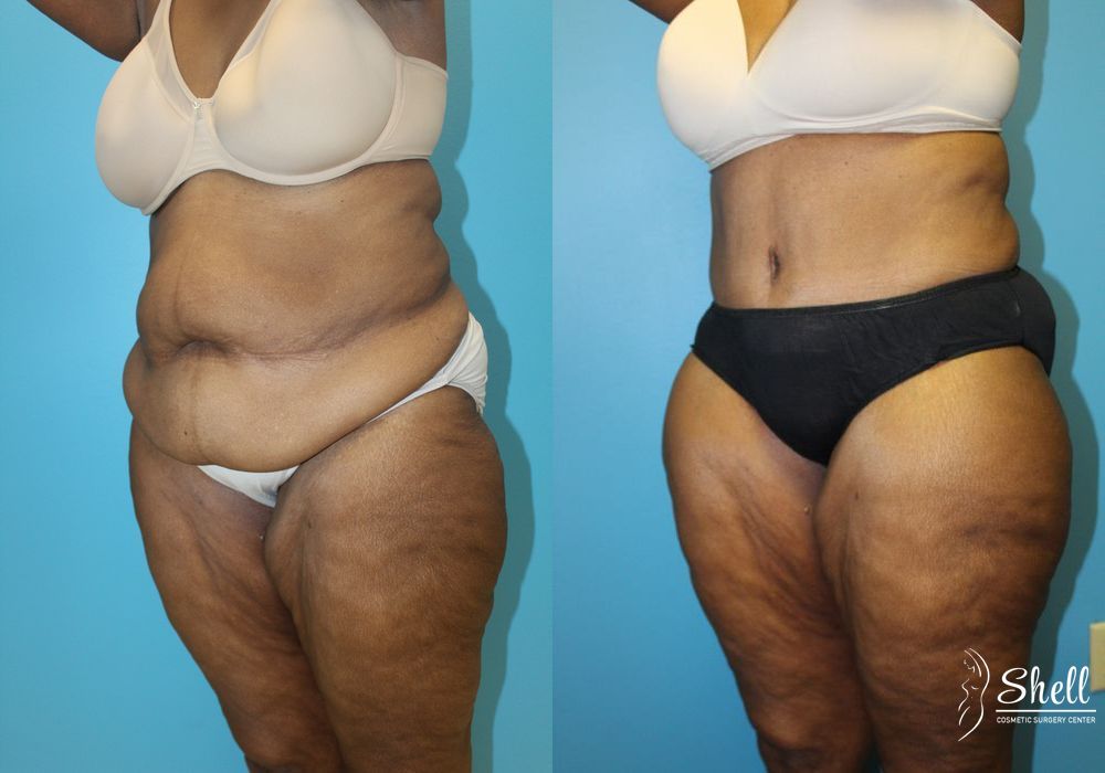 Before and after Liposuction case 21574 - Angle 4