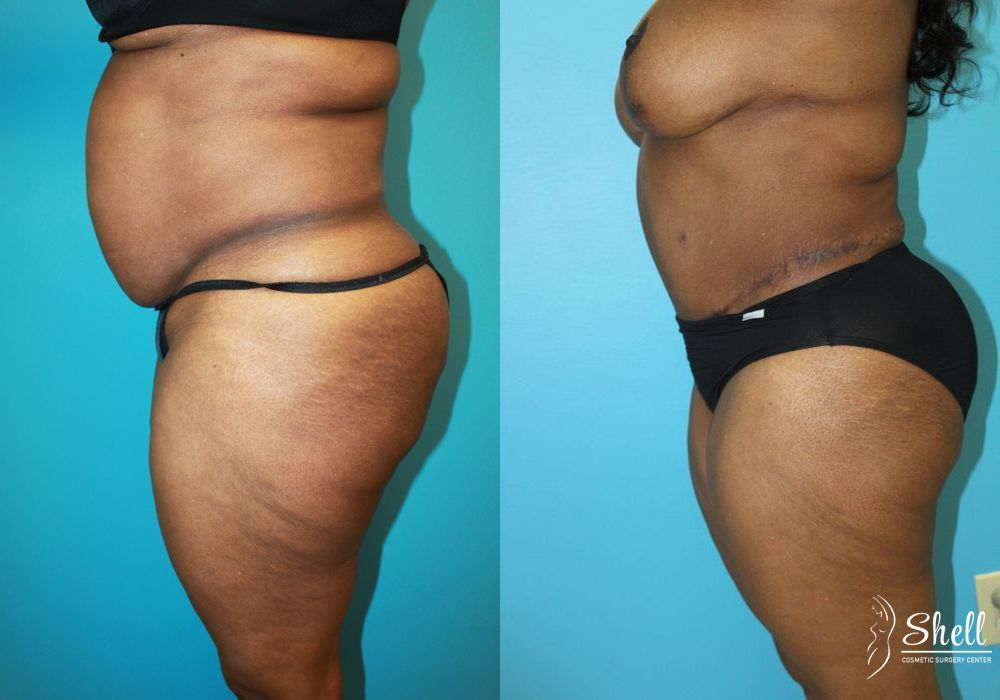 Liposuction - Thumbnail 5