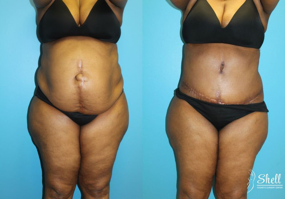 Tummy Tuck - Case 458