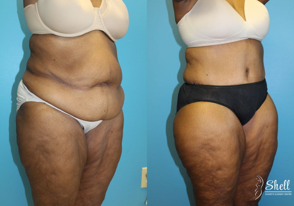 Liposuction - Thumbnail 2