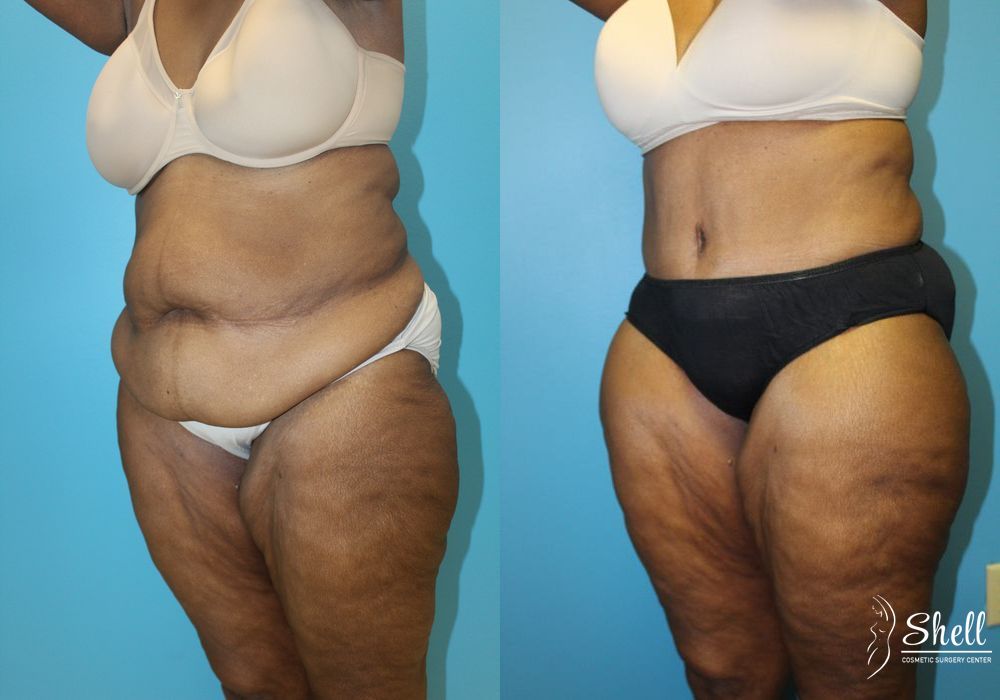 Liposuction - Thumbnail 4