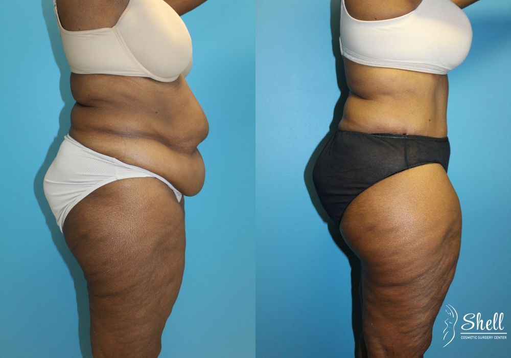 Liposuction - Thumbnail 3