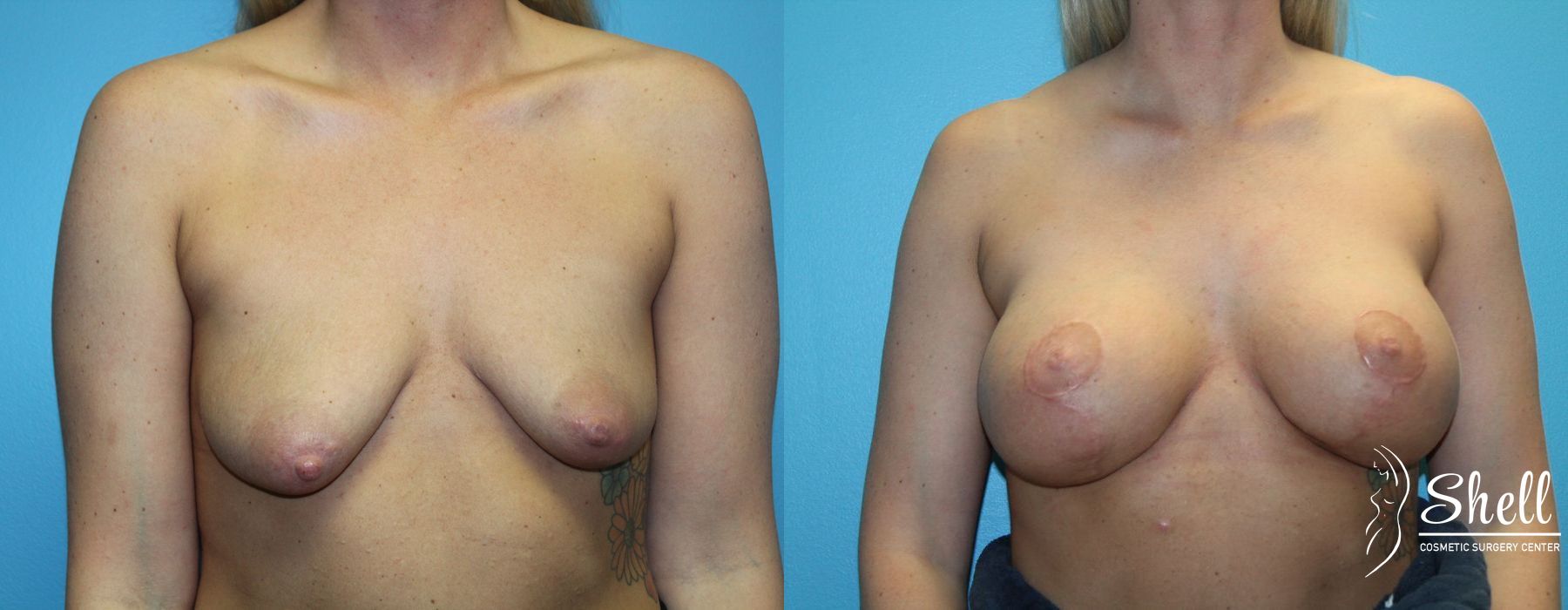 Breast Augmentation with Lift - Thumbnail 2