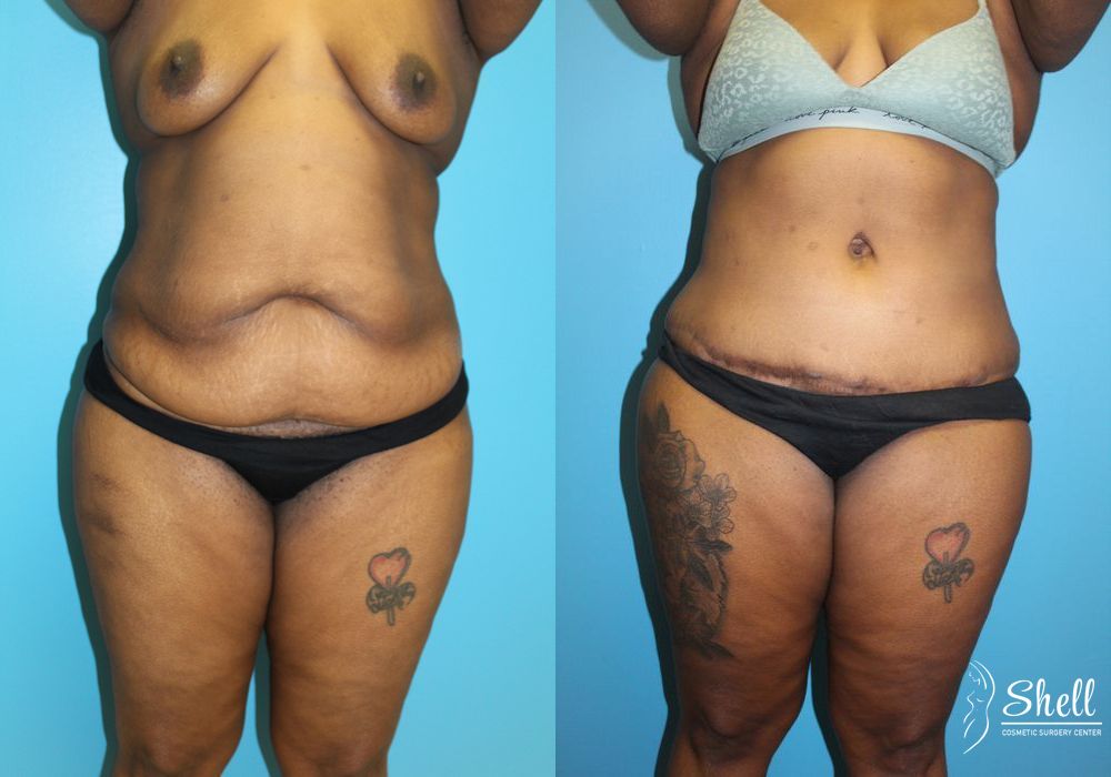 Liposuction - Case 453