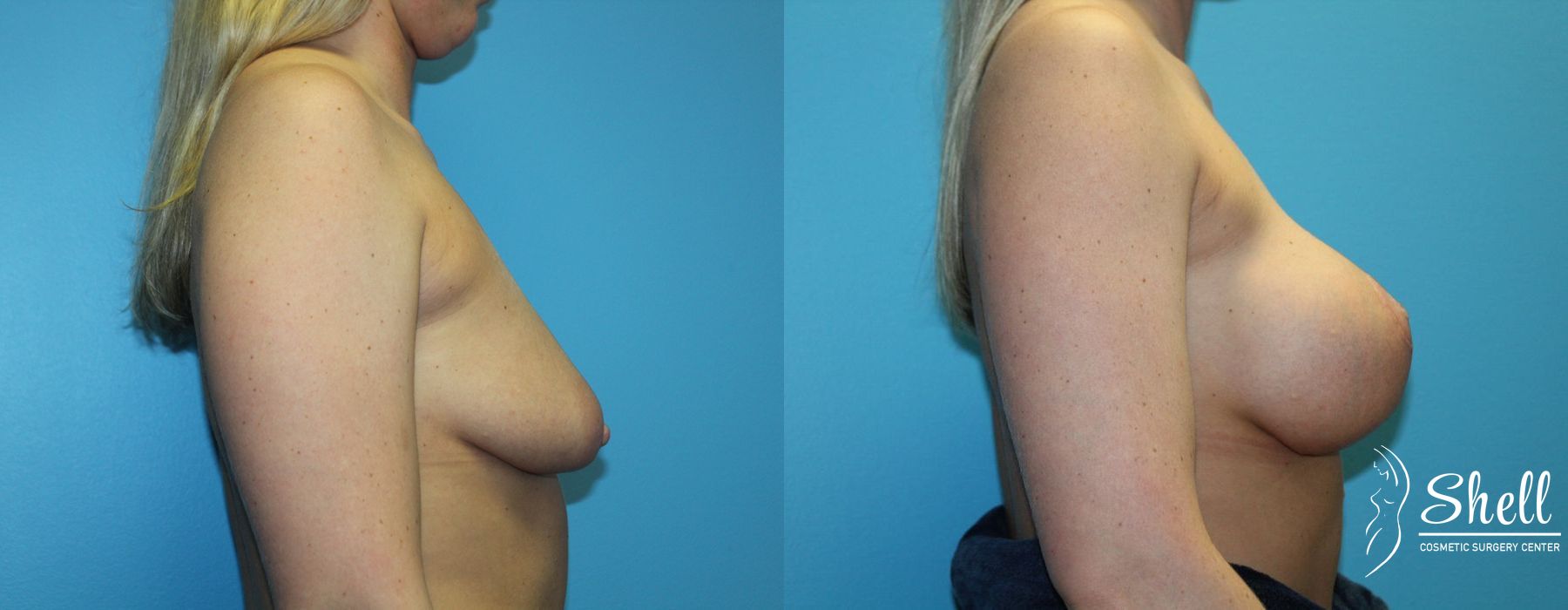 Breast Augmentation with Lift - Thumbnail 5