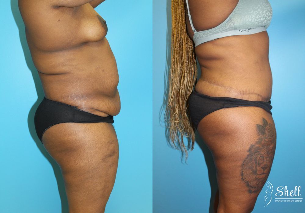 Liposuction - Thumbnail 3