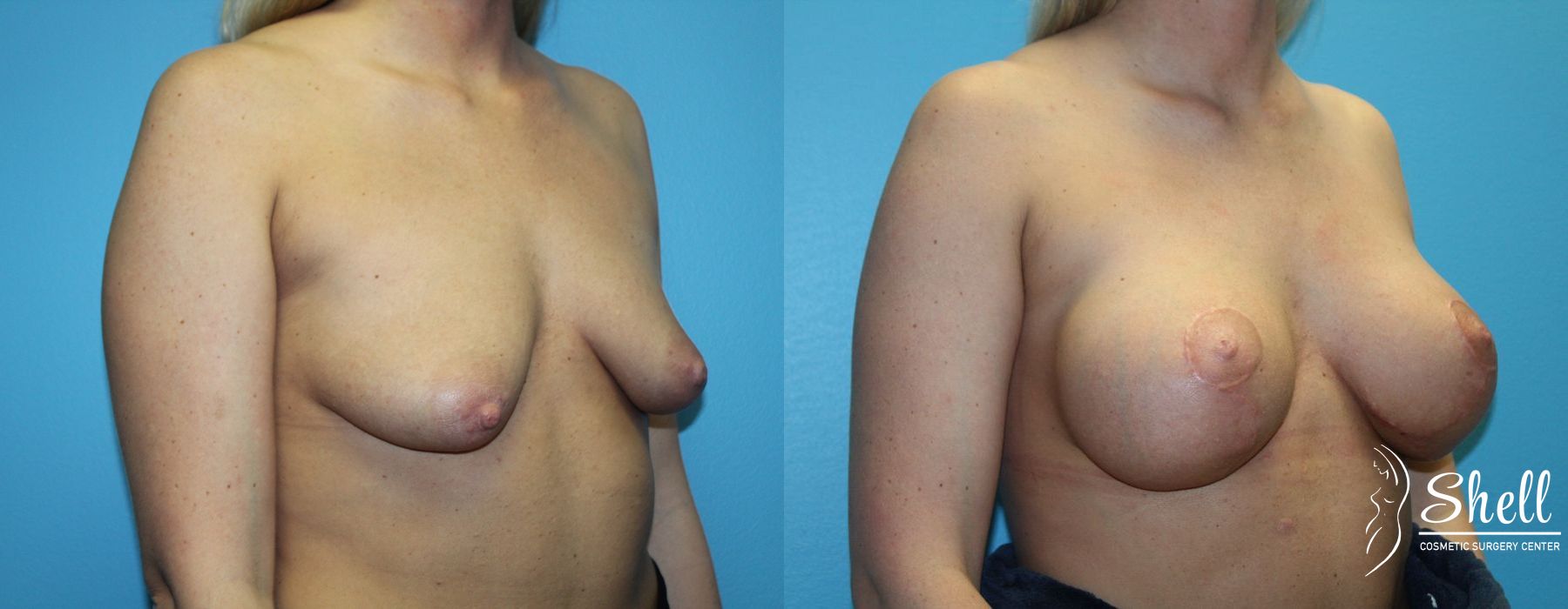 Breast Augmentation with Lift - Thumbnail 4