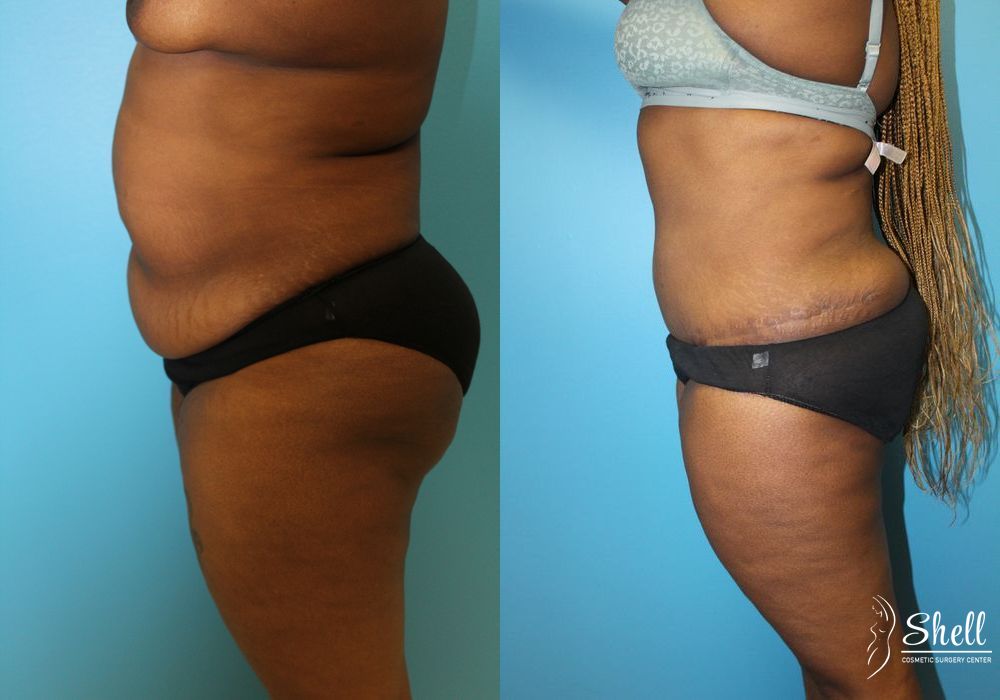 Liposuction - Thumbnail 5