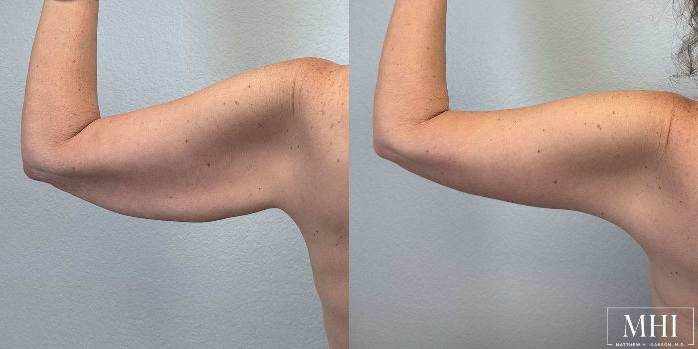 Arm Lift - Thumbnail 2