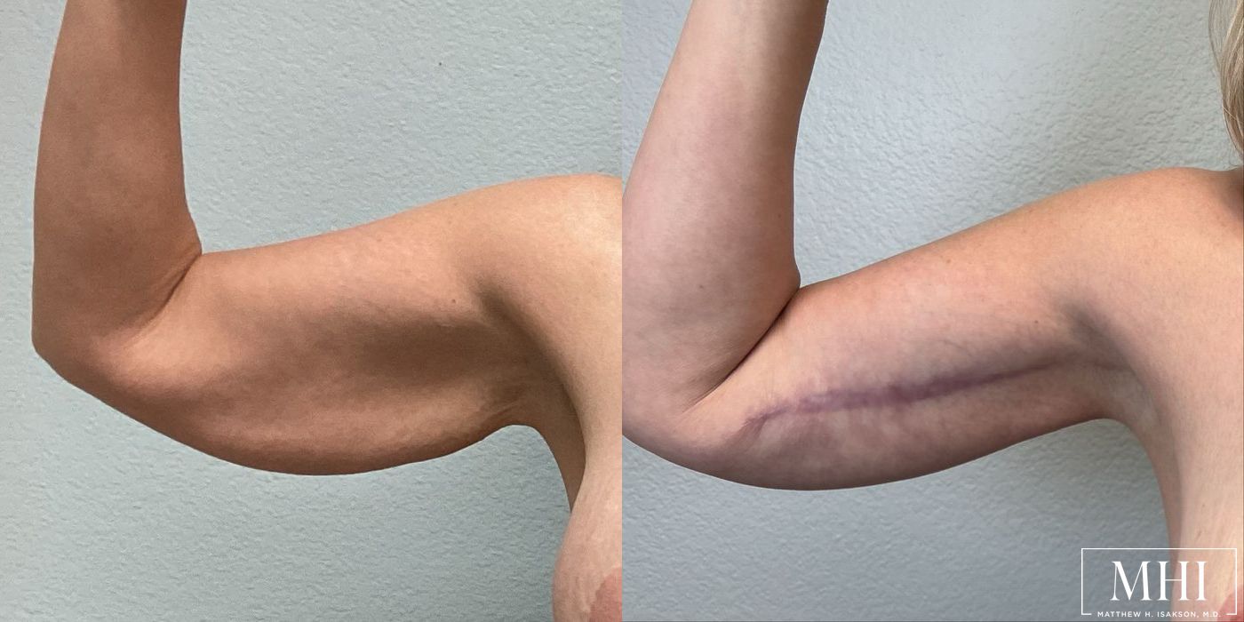 Arm Lift - Case 12347