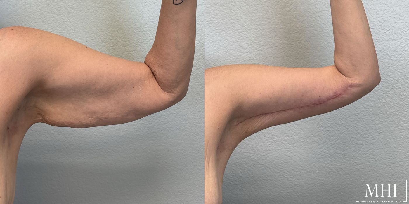 Arm Lift - Thumbnail 5