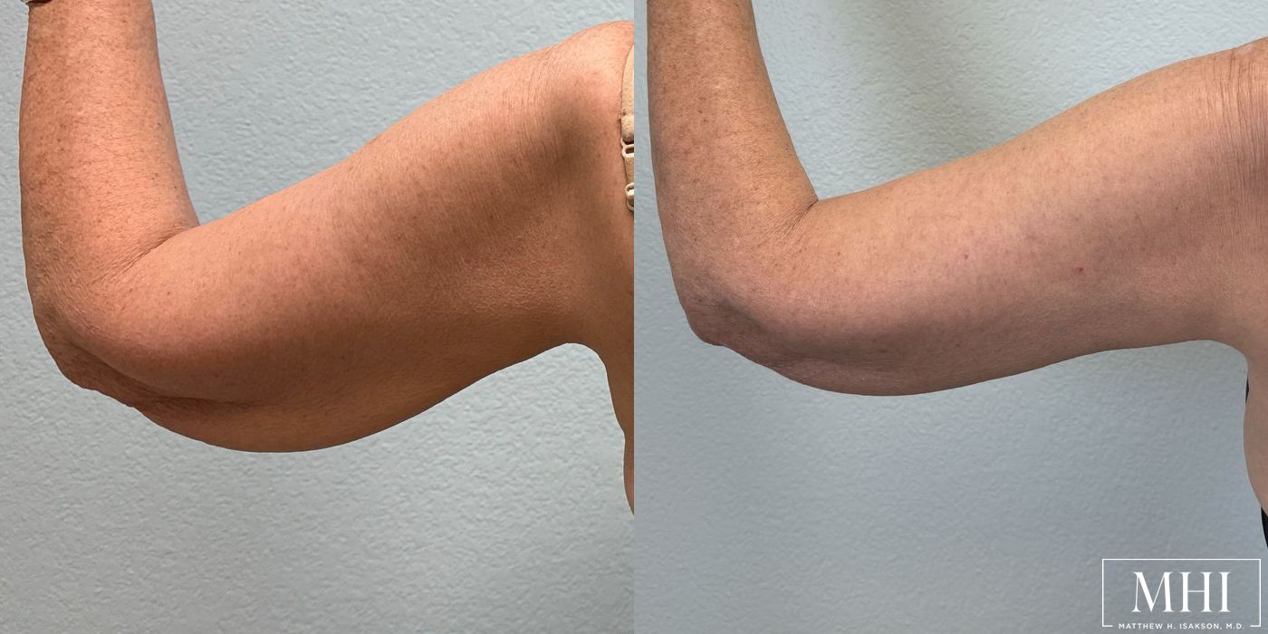 Arm Lift - Case 12350