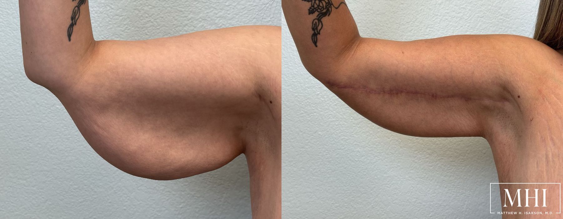 Arm Lift - Case 12352