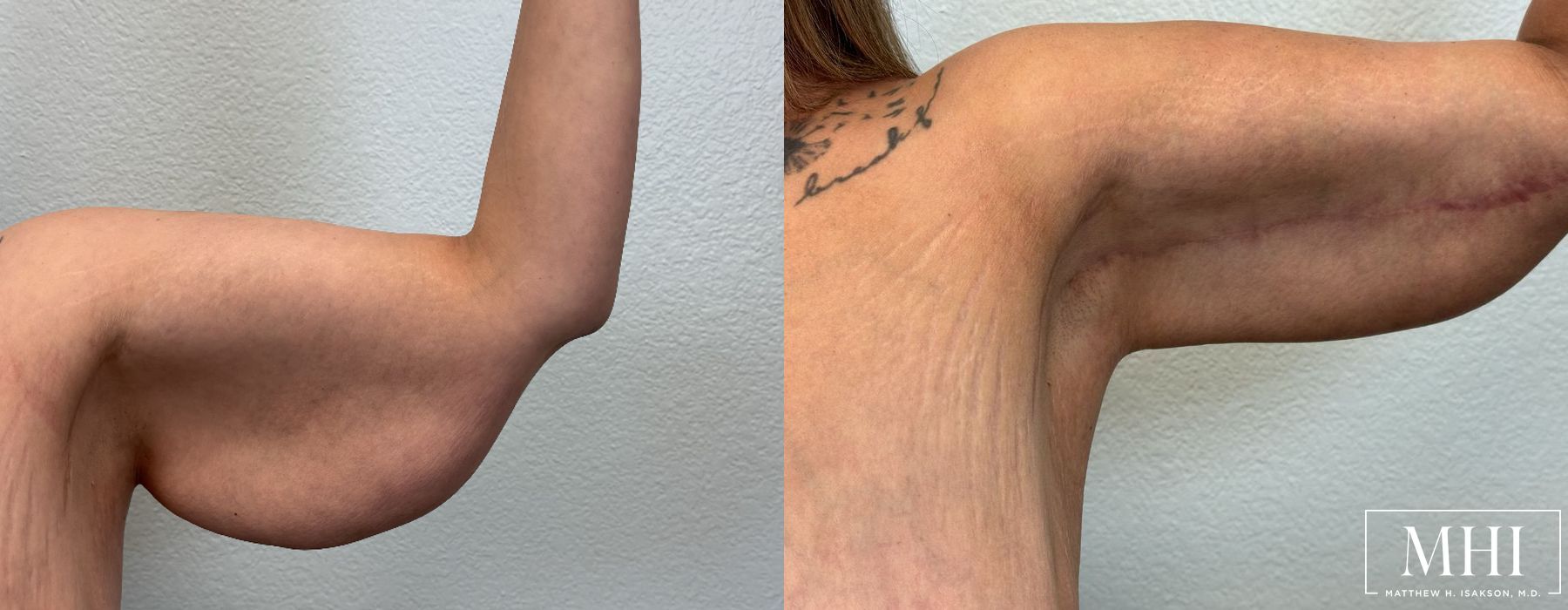 Arm Lift - Thumbnail 2