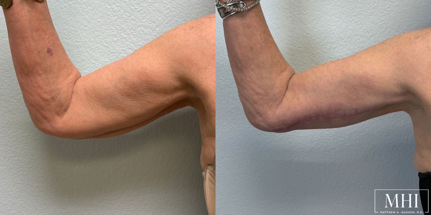 Arm Lift - Thumbnail 3