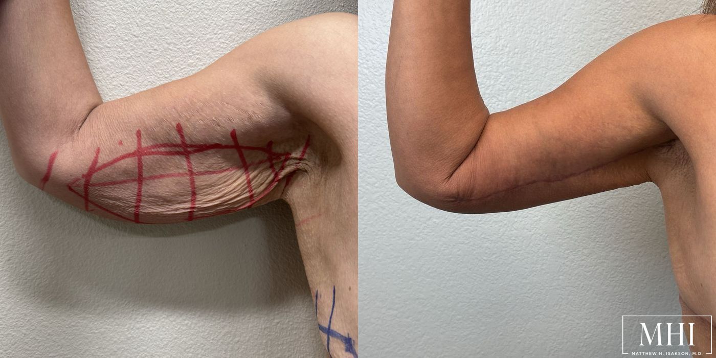 Arm Lift - Case 12351