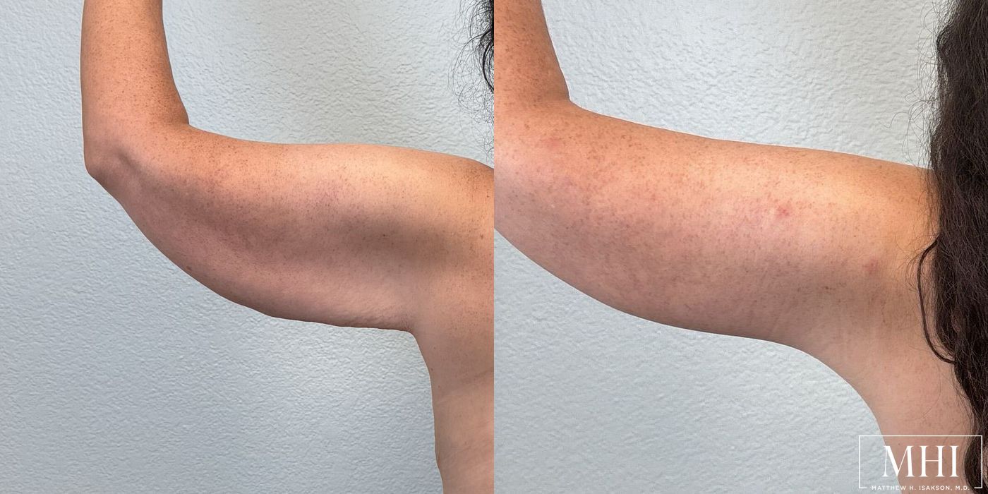 Arm Lift - Case 12348