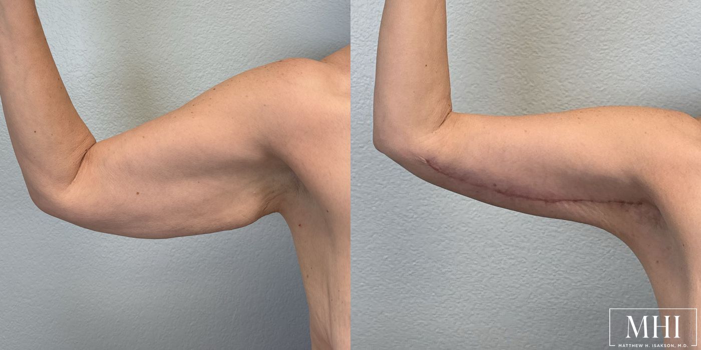 Arm Lift - Thumbnail 4