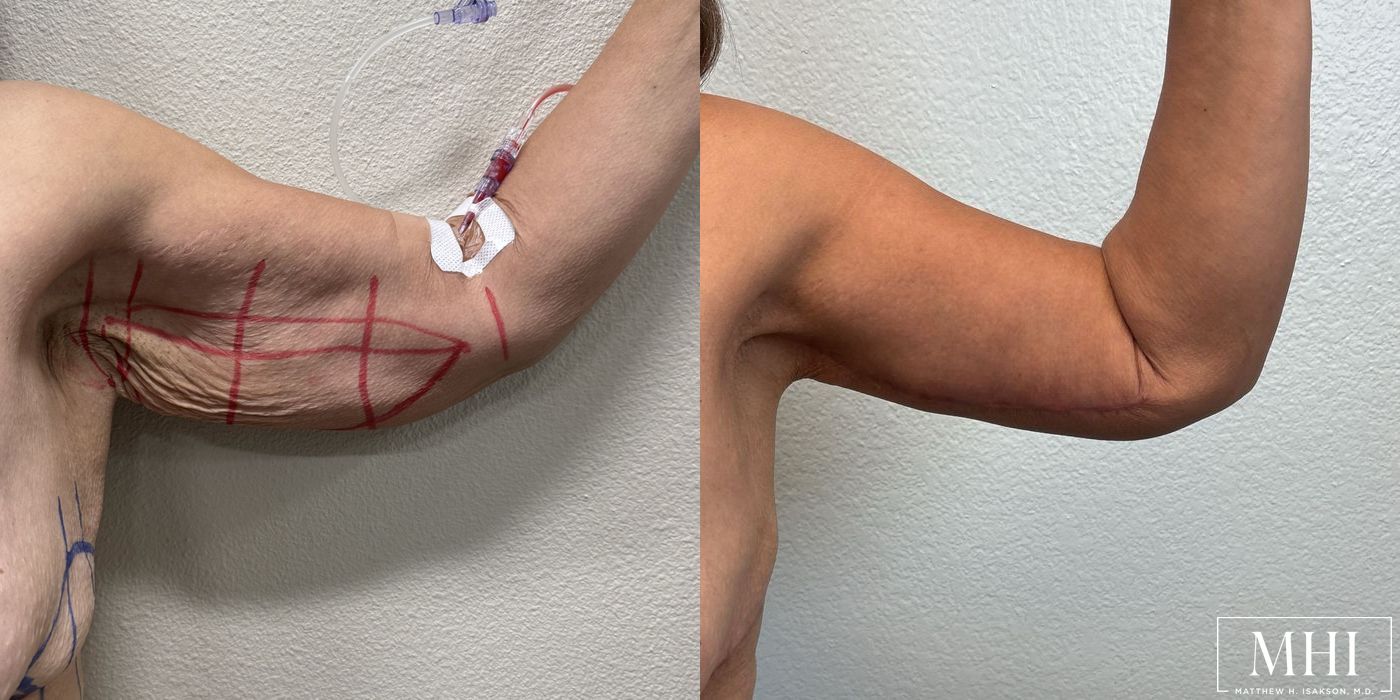 Arm Lift - Thumbnail 2