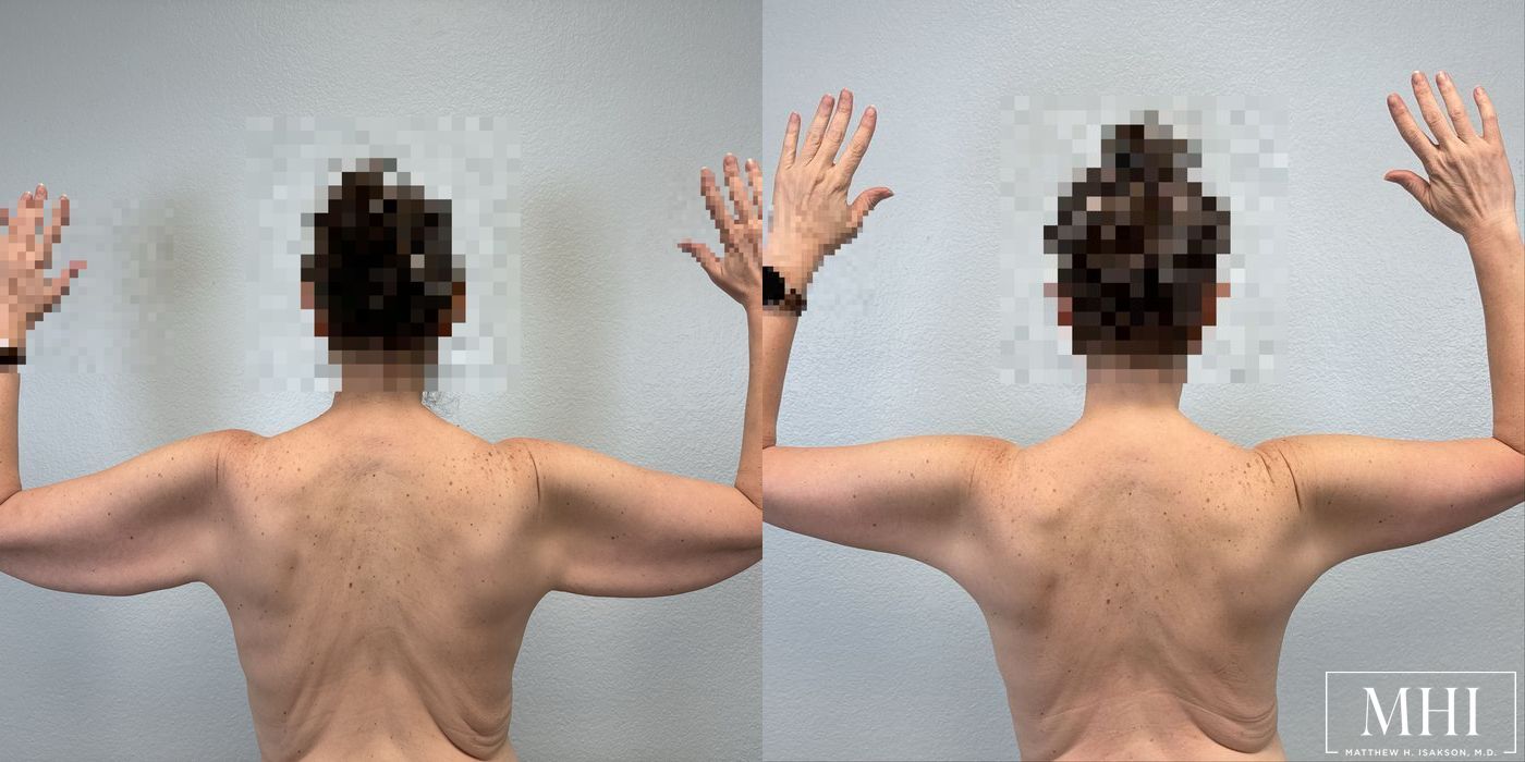 Arm Lift - Case 12349