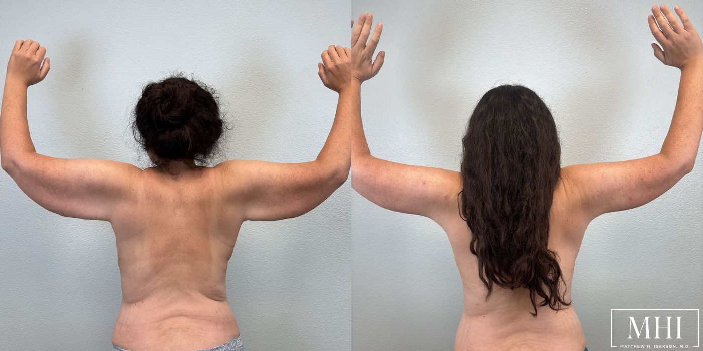 Arm Lift - Thumbnail 3