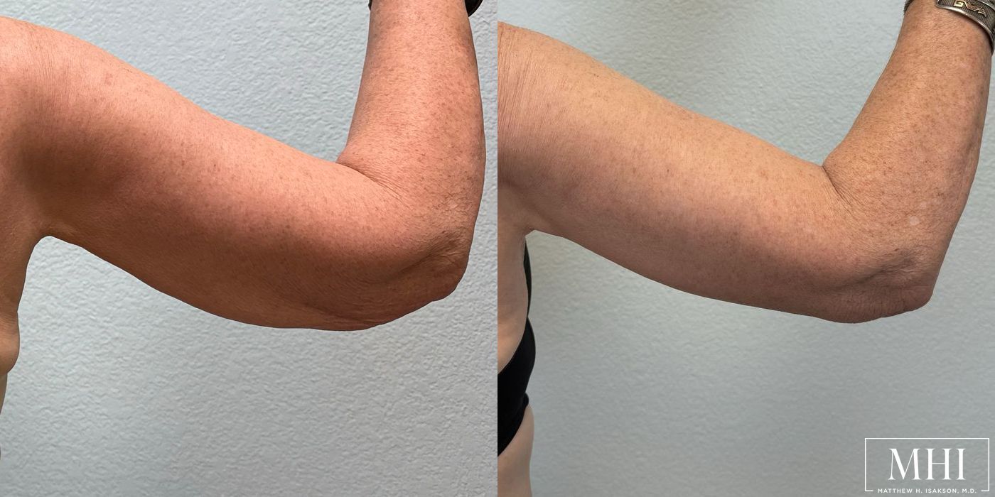 Arm Lift - Thumbnail 2