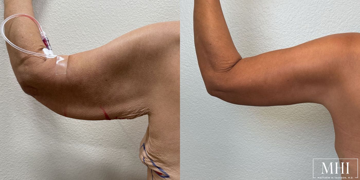 Arm Lift - Thumbnail 3