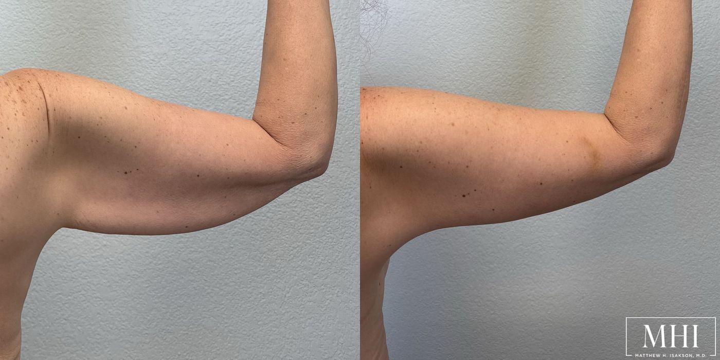 Arm Lift - Thumbnail 3