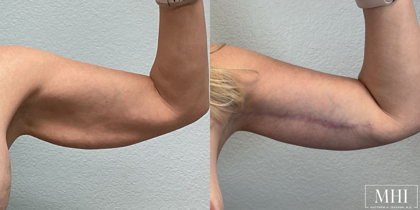 Arm Lift - Thumbnail 2