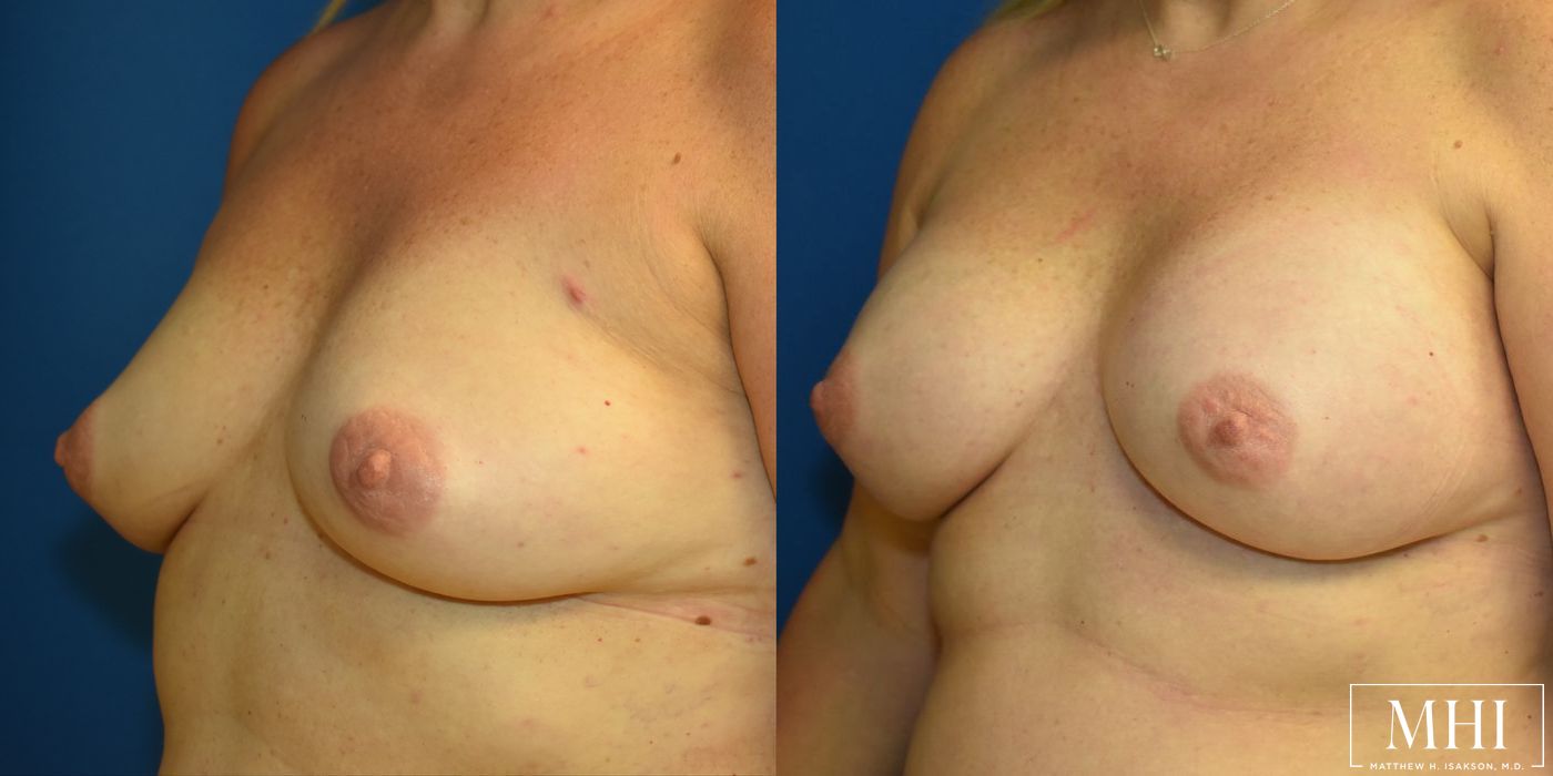 Breast Augmentation - Thumbnail 2