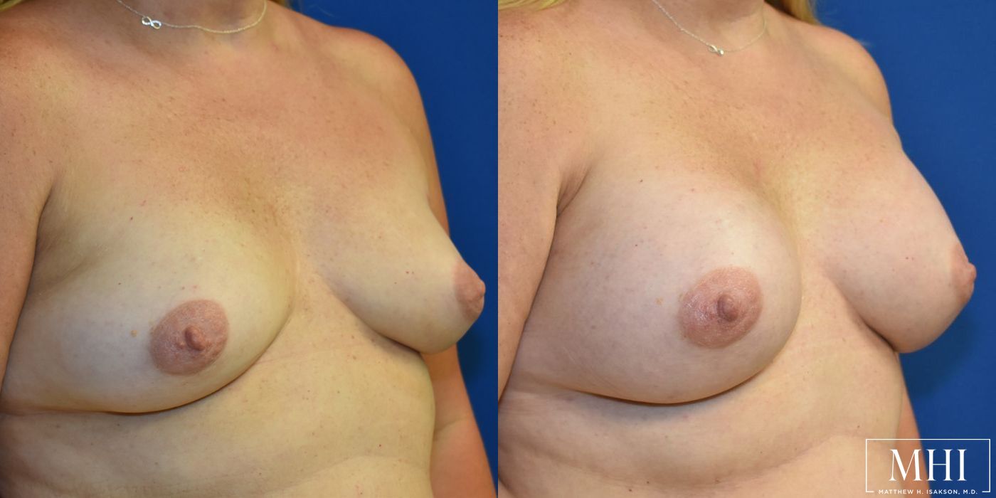 Breast Augmentation - Thumbnail 4