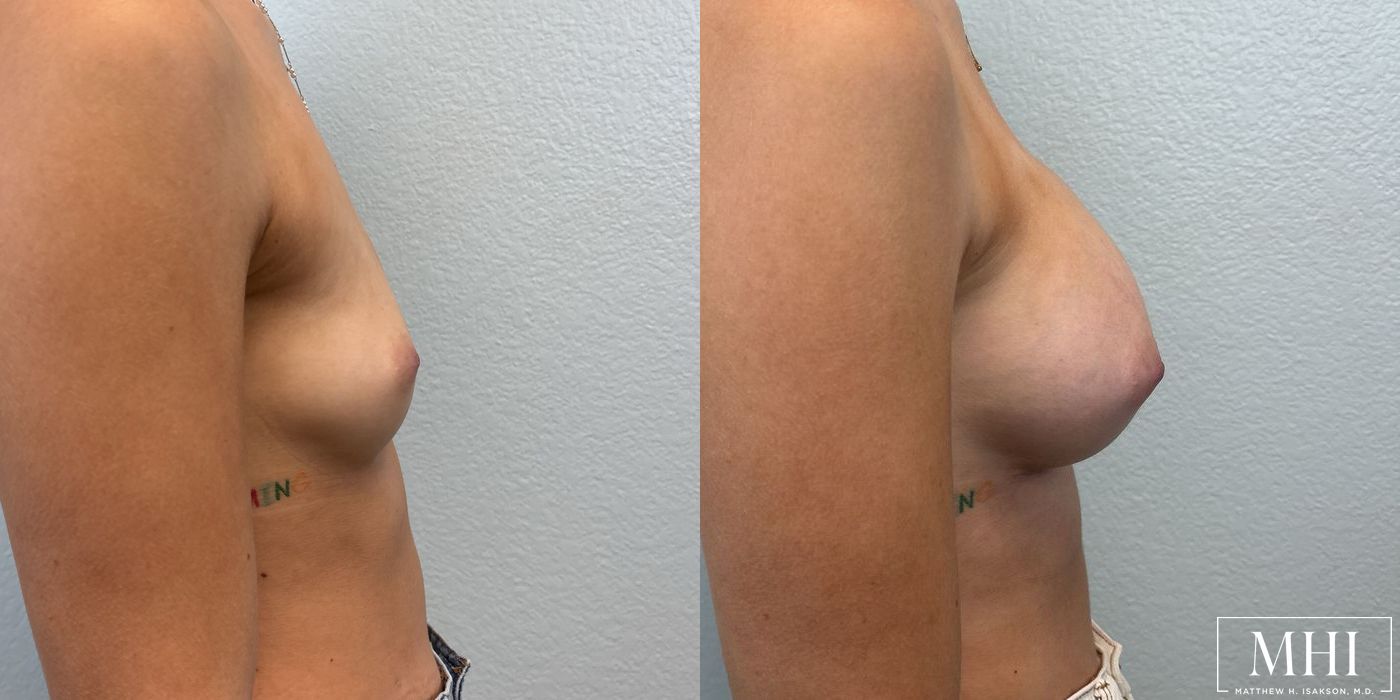 Breast Augmentation - Thumbnail 2