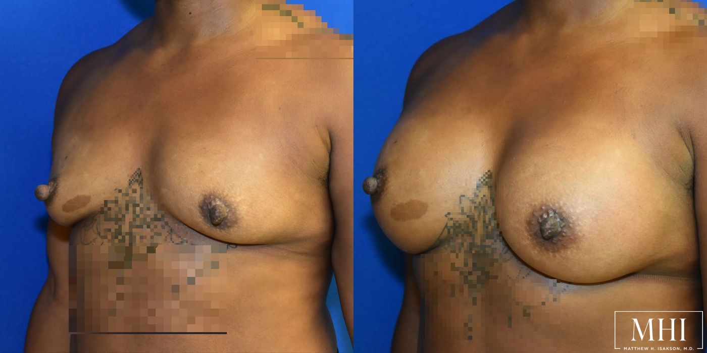 Breast Augmentation - Thumbnail 4